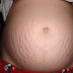 Suggerimenti per una dieta sana per prevenire le smagliature in gravidanza