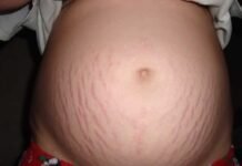 Suggerimenti per una dieta sana per prevenire le smagliature in gravidanza