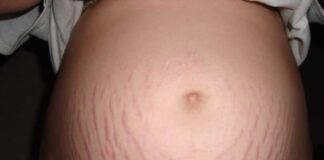 Suggerimenti per una dieta sana per prevenire le smagliature in gravidanza